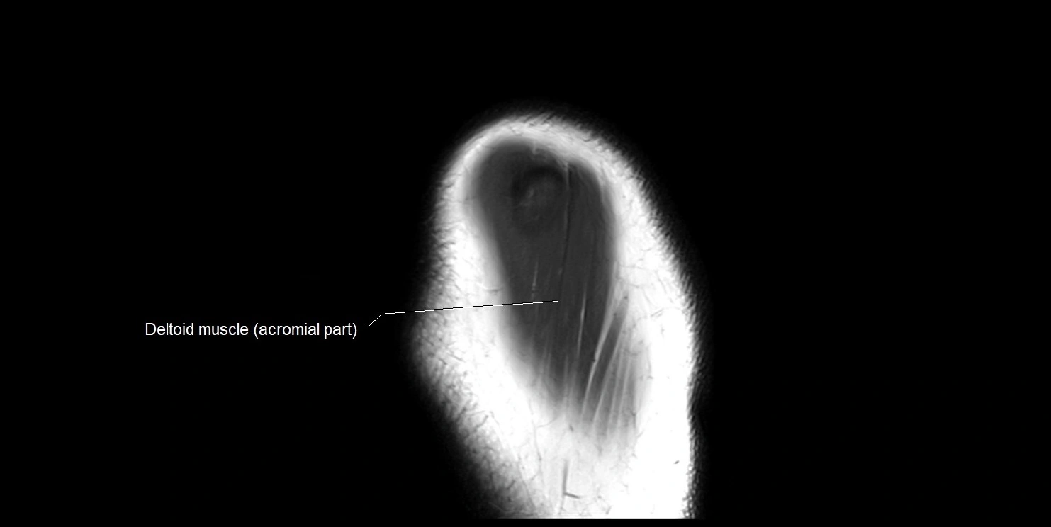 mri shoulder sagittal cross sectional anatomy image 19.webp